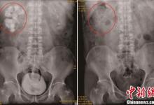 廣東手足口病病例下降近半