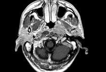 “無(wú)創(chuàng)DNA產(chǎn)檢”之父新成果：通過(guò)血液篩查早期鼻咽癌