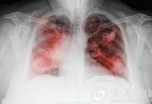 歐洲醫(yī)學(xué)新發(fā)現(xiàn):免疫細(xì)胞新發(fā)現(xiàn)有助于開(kāi)發(fā)慢性肺炎療法