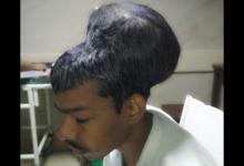 印度醫(yī)生摘除全球“最大腦瘤” 重達(dá)1.8公斤