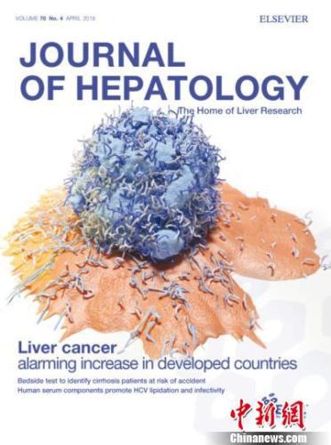 中國(guó)學(xué)者率先系統(tǒng)解析全球不同地區(qū)肝癌發(fā)病模式