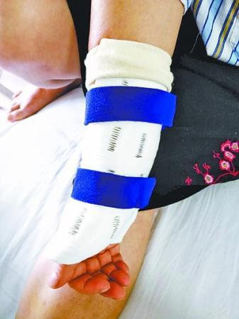 武漢首個玉米淀粉3D打印支具“上手”-易網<a href=http://www.xllyou.com/ target=_blank class=infotextkey>健康養生</a>網 武漢首個玉米淀粉3D打印支具“上手”