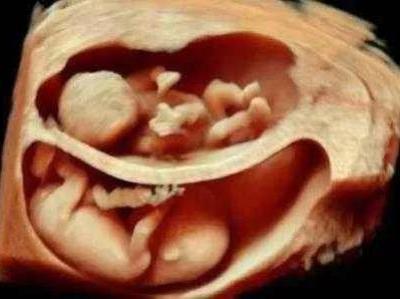 懷了雙胞胎又驚喜又擔(dān)憂，唐山寶島婦兒醫(yī)院為您保駕護航