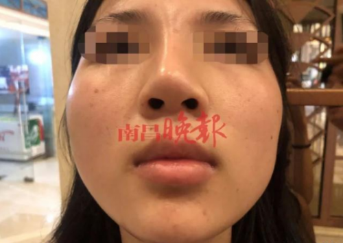 南昌禾麗整形醫院把我鼻子整歪了 記者介入協調才同意免費修復-易網健康<a href=http://www.xllyou.com/jkys/ target=_blank class=infotextkey>養生</a>網 南昌禾麗整形醫院把我鼻子整歪了 記者介入協調才同意免費修復