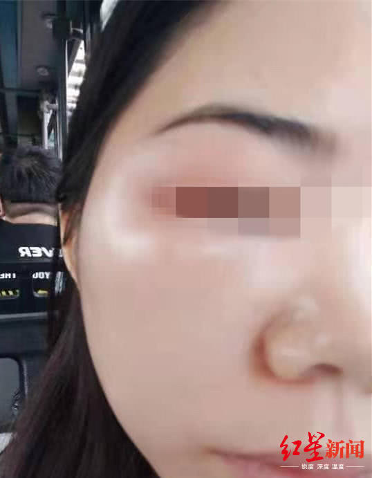 女子在宜賓韓美整形后差點毀容 醫(yī)院:個體差異-易網(wǎng)健康<a href=http://www.xllyou.com/jkys/ target=_blank class=infotextkey>養(yǎng)生</a>網(wǎng) 女子在宜賓韓美整形后差點毀容 醫(yī)院:個體差異