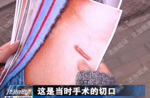 鄭州新生醫(yī)院隆鼻失敗 假體往外透院方稱沒法解決-易網(wǎng)健康<a href=http://www.xllyou.com/jkys/ target=_blank class=infotextkey>養(yǎng)生</a>網(wǎng) 鄭州新生醫(yī)院隆鼻失敗 假體往外透院方稱沒法解決