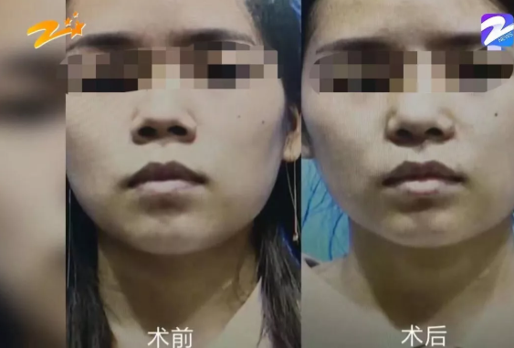 杭州甄美整形醫院把人鼻子整歪了?醫院:自己長歪了-易網健康<a href=http://www.xllyou.com/jkys/ target=_blank class=infotextkey>養生</a>網 杭州甄美整形醫院把人鼻子整歪了?醫院:自己長歪了