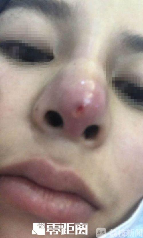南京塑美顏整形門診涉嫌超范圍經營 女孩隆鼻后鼻孔大小不一
