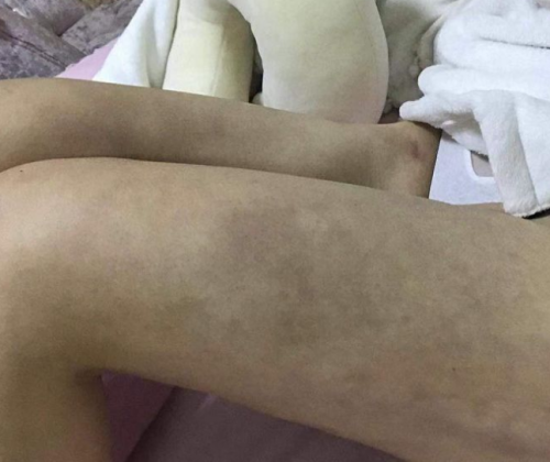 南昌亞太醫療美容醫院抽脂手術后情況很糟糕 女子維權卻被罵出來