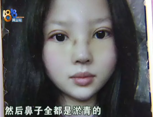 女子在嘉興長(zhǎng)紅門診部整形后整個(gè)人都崩潰了 姑娘采訪從頭哭到尾-易網(wǎng)<a href=http://www.xllyou.com/ target=_blank class=infotextkey>健康養(yǎng)生</a>網(wǎng) 女子在嘉興長(zhǎng)紅門診部整形后整個(gè)人都崩潰了 姑娘采訪從頭哭到尾