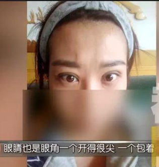 貸款6萬多在西安華醫天美整形醫院整容后變丑了 女子流下后悔的眼淚-易網<a href=http://www.xllyou.com/ target=_blank class=infotextkey>健康養生</a>網 貸款6萬多在西安華醫天美整形醫院整容后變丑了 女子流下后悔的眼淚