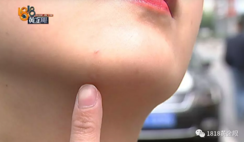 杭州珈禾醫療美容醫院遭投訴：花了2萬溶脂瘦臉 竟然沒效果