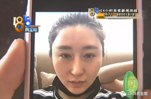 杭州華山連天美整形醫院把我鼻子做歪了 整的像阿凡達-易網<a href=http://www.xllyou.com/ target=_blank class=infotextkey>健康養生</a>網 杭州華山連天美整形醫院把我鼻子做歪了 整的像阿凡達