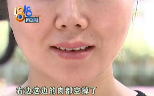 杭州維多利亞醫療美容醫院溶脂術后不如從前好看 整個人顯得很憔悴-易網<a href=http://www.xllyou.com/ target=_blank class=infotextkey>健康養生</a>網 杭州維多利亞醫療美容醫院溶脂術后不如從前好看 整個人顯得很憔悴