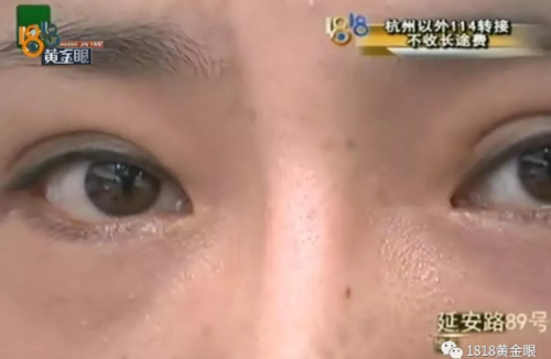 女子在紹興華美整形醫院整形后眼睛有異物感 鼻子也被整成像阿凡達