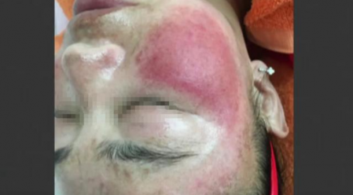 成都:莊美斑敏痘激素臉修復中心祛斑 剛回去臉上出現密密麻麻紅疹-易網<a href=http://www.xllyou.com/ target=_blank class=infotextkey>健康養生</a>網 成都:莊美斑敏痘激素臉修復中心祛斑 剛回去臉上出現密密麻麻紅疹