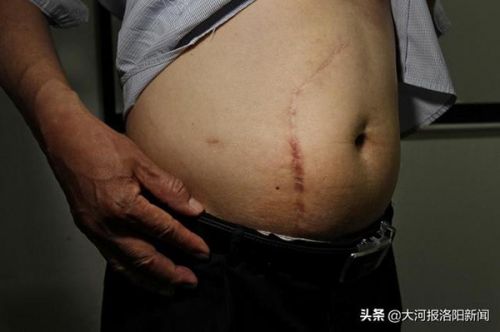 13年前只在洛陽市商業職工醫院做過一次闌尾手術 為何膽囊不見了?-易網健康<a href=http://www.xllyou.com/jkys/ target=_blank class=infotextkey>養生</a>網 13年前只在洛陽市商業職工醫院做過一次闌尾手術 為何膽囊不見了?