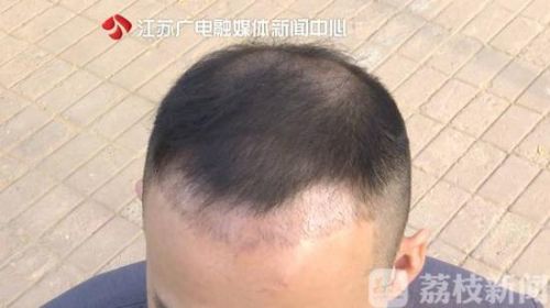 南京美貝爾整形醫院聲稱植發成活率95% 可植發一個月掉了一半-易網健康<a href=http://www.xllyou.com/jkys/ target=_blank class=infotextkey>養生</a>網 南京美貝爾整形醫院聲稱植發成活率95% 可植發一個月掉了一半