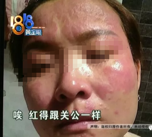 本想“逆時光” 結果密思芬美容后臉紅得像關公不敢見人-易網<a href=http://www.xllyou.com/ target=_blank class=infotextkey>健康養生</a>網 本想“逆時光” 結果密思芬美容后臉紅得像關公不敢見人