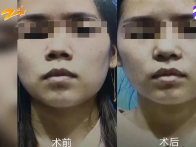 杭州甄美整形醫(yī)院把人鼻子整歪了？醫(yī)院：自己長(zhǎng)歪了