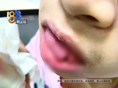 去杭州艾維口腔補牙舌頭被劃傷縫八針 疼的渾身發抖