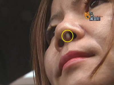 六年前在寧波珈禾整形專科醫(yī)院做隆鼻 現(xiàn)在鼻子不舒服露出白色假體