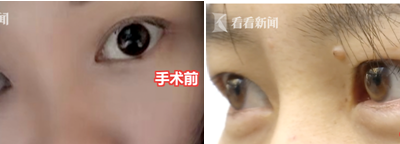 貴陽聚星妍美整形機構又出問題了 雙眼皮整成了單眼皮?