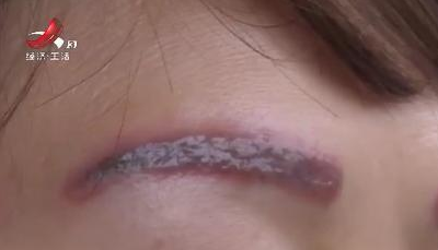 去南昌韓美美容醫院激光洗眉后生不如死 洗完感覺自己像怪物