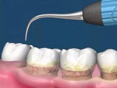 杭州美奧口腔怎么樣?洗牙能去除煙漬嗎