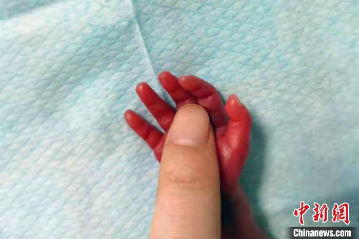 皮膚薄如紙體重780g 湖北一超早產(chǎn)兒經(jīng)救治順利脫險