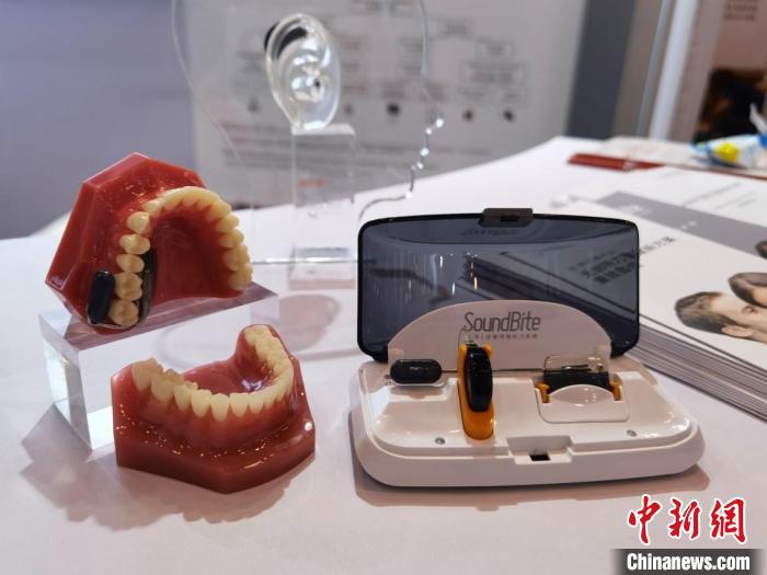 牙骨傳導為聽力重建領域注入活力 專家呼吁盡早干預術后聽力問題