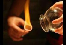 拔罐常用體位有4種 操作時需注意這些