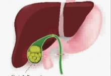 如何護理膽結石？高危人群要注意