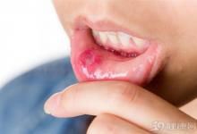 5個偏方 助你輕松“搞定”口腔潰瘍!