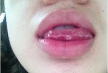 口腔潰瘍痛到發瘋，3個小妙招可快速治愈