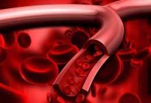 小心！血管都是被這幾個壞習慣毀掉的