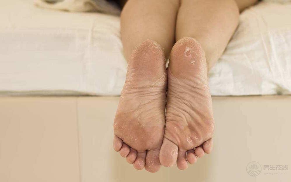 腳氣也是一種病,做到這一點能夠有效預防腳氣 腳氣也是一種病,做到這一點能夠有效預防腳氣