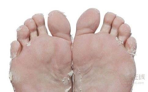 腳氣也是一種病,做到這一點能夠有效預防腳氣 腳氣也是一種病,做到這一點能夠有效預防腳氣