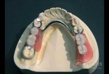 義齒有哪幾類,什么是義齒