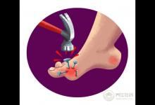 尿酸高的人注意,這3類食物碰多了,腎會(huì)“壞掉”!