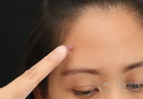 痘痘星人看過來,這3種食物咱別吃了,再好吃為了美也要忍 痘痘星人看過來,這3種食物咱別吃了,再好吃為了美也要忍