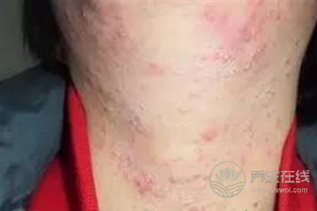 激素性皮炎不能吃什么? 激素性皮炎不能吃什么?