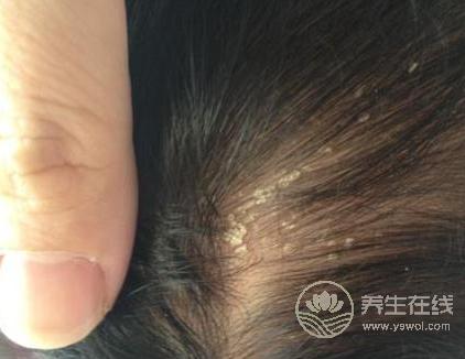 頭皮屑多很尷尬?不妨多吃這幾種食物 頭皮屑多很尷尬?不妨多吃這幾種食物