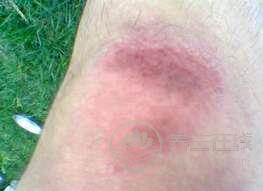 扭傷后的處理小妙方 扭傷后的處理小妙方