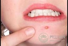 經期狂長痘痘怎么回事?排毒調理才是關鍵