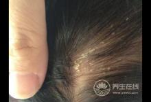 頭皮屑多很尷尬？不妨多吃這幾種食物