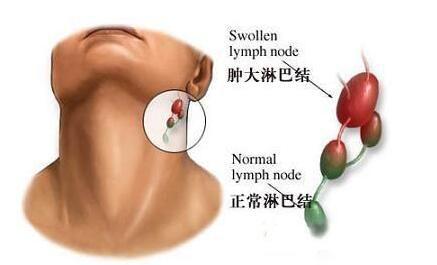 淋巴結(jié)排毒的方法以及定期排毒的好處