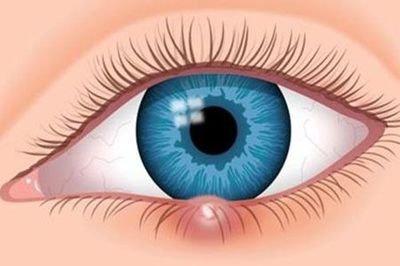 早期的麥粒腫應(yīng)該采取哪些手段消除