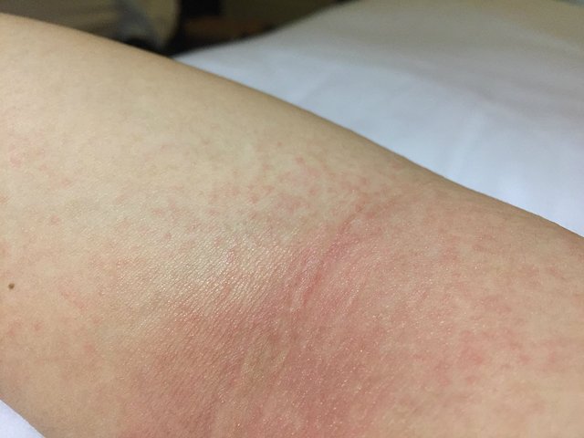 在皮膚起疹子的期間人們可以洗澡嗎 在皮膚起疹子的期間人們可以洗澡嗎