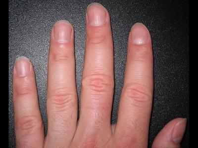 指甲有豎棱的原因以及體現(xiàn)出了什么